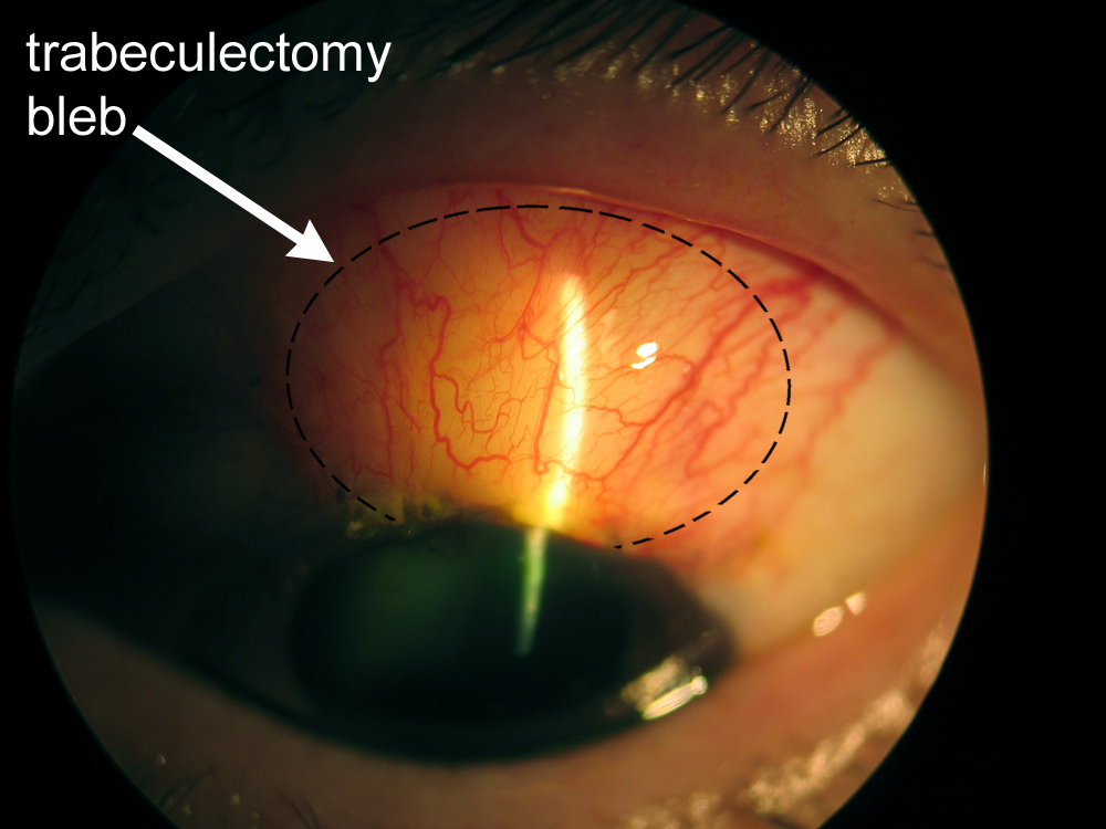 Trabeculectomy Surgery